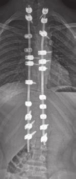 More extensive loosening may be added by performing spine Osteotomies (see below: Spine Osteotomies). Metal rods are anchored to the spine by screws, hooks, cables, or wires.