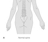 Disorders Scoliosis Diagnosed in