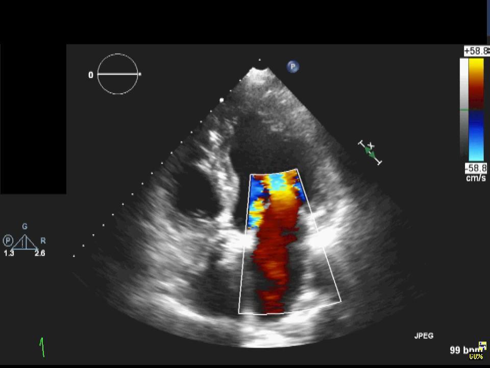 Transcatheter aortic valve implantation (Edwards Sapien XT 26 mm;