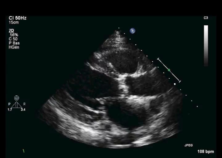 Case #2 80 y-o woman, severe aortic stenosis
