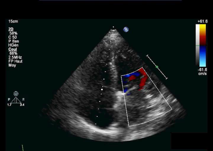 Transcatheter aortic valve implantation (Edwards Sapien 23 mm;