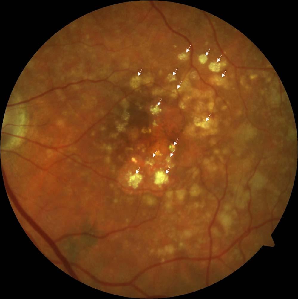Refractile Drusen and GA Development IOVS j April 2017 j Vol. 58 j No. 4 j 2199 than AMD (e.g., diabetic retinopathy, glaucoma, retinal vessel occlusion, retinal dystrophies, and uveitis).