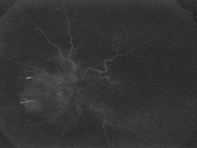 Prominent exudation, intraretinal hemorrhage and tortuosity of the retinal vessels are