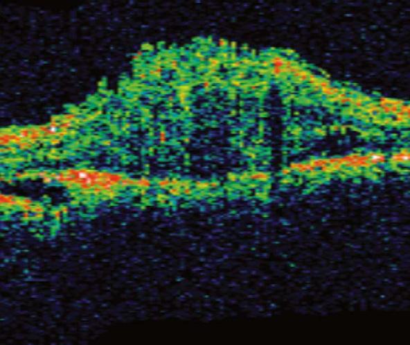 cause blurring of the optic disc margins and may be mistaken for papilledema. Autofluorescence confirms this surface drusen in over 96% of cases [6].