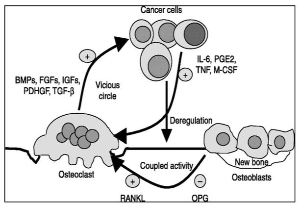 6 Figure 2 The Vicious Cycle of Bone Metastasis Communication between bone cells and invading cancer cells leads to a cycle of increased bone resorption and cancer cell growth.