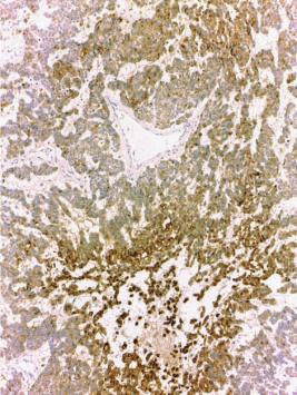 Sertoli cell tumor is an important differential diagnosis of an ovarian tumor with a tubular pattern in young women [5].