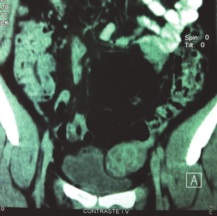 2 Case Reports in Oncological Medicine Figure 1: Contrast-enhanced abdominal CT revealing tumour on left ovary. a TSH of <0.01 miu/ml and a free T4 of 2.6 ng/dl.