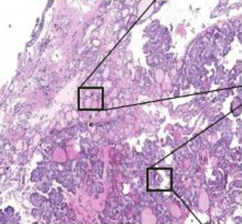 Case Reports in Oncological Medicine 3 Figure 2: Malignant struma ovarii with classic variant papillary thyroid cancer.