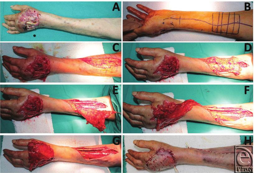 AKDAG ET AL Figure 1. (a) The defect of the dorsum of the hand in a 67 years old woman. (b) Flap dimensions are designed according to the size of the defect. (c) Skin incision.