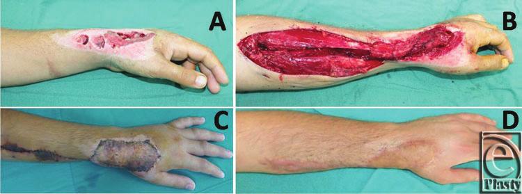 AKDAG ET AL Figure 5. (a) Dorsal hand defect. (b) Flap transposition. (c) Early postoperative result. (d) Late postoperative result. Figure 6. (a) Dorsal hand defect in a 31 years old man.