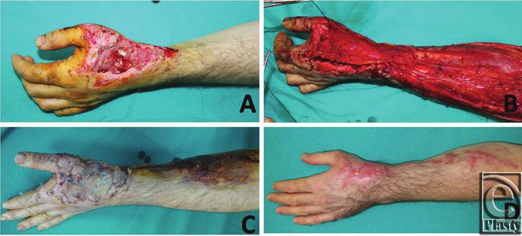 DISCUSSION In this study, soft-tissue hand defects were reconstructed successfully in 13 patients using an RARFF, which used only the adipofascial component of a traditional reverse radial forearm