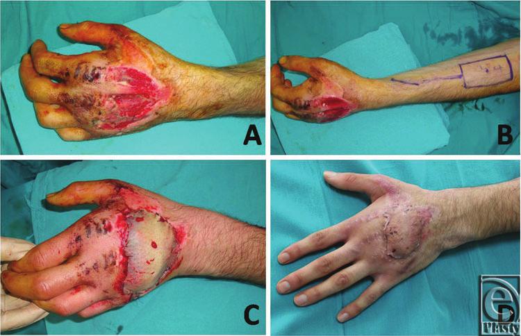 eplasty VOLUME 16 sacrifice of a major artery that may jeopardize hand viability.