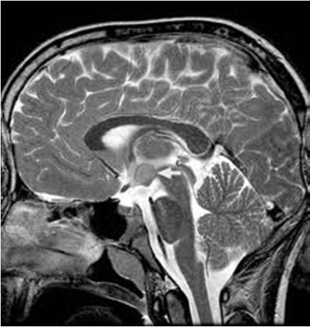 - MRI = hypothalamic - hamartoma Barrow Neurological Institute Lupron started age