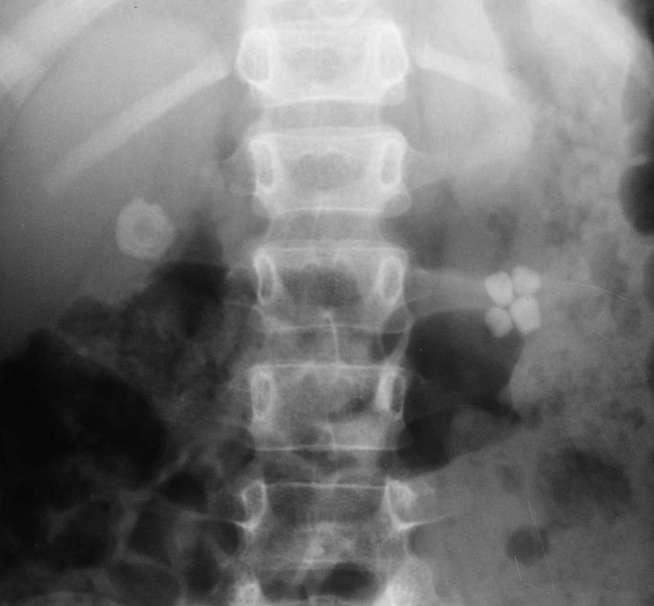 8 years/male child. Presented with pain and hematuria.