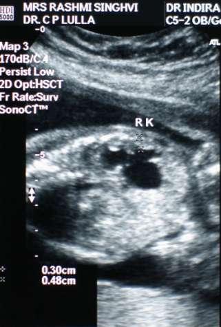 24 weeks antenatal USG, primi 29 yrs, IVF