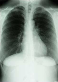 Radiologic Exam CXR must be done Must be normal Or IF abnormal: Not consistent with Active TB Stable abnormality confirmed over a 3 month period Clinical Evaluation: CXR Findings associated with