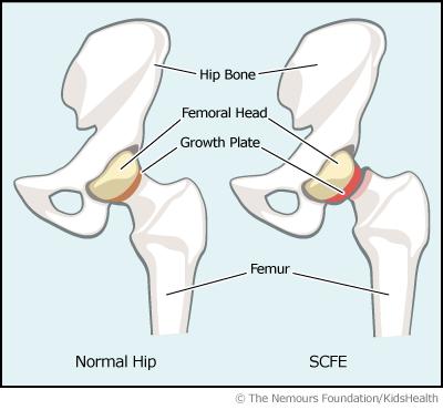 Slipped capital femoral epiphysis (SCFE) o Displacement of the femoral neck from the capital femoral epiphysis which remains in the acetabulum.
