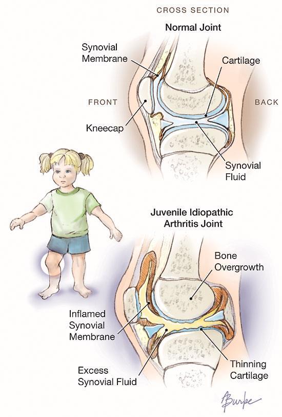 o Juvenile Idiopathic Arthritis is defined as definite arthritis of unknown etiology beginning before the age of 16 years and lasting for at least 6 weeks.
