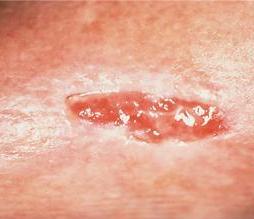 Moist Wound Therapy Exude Managaement Exudate has