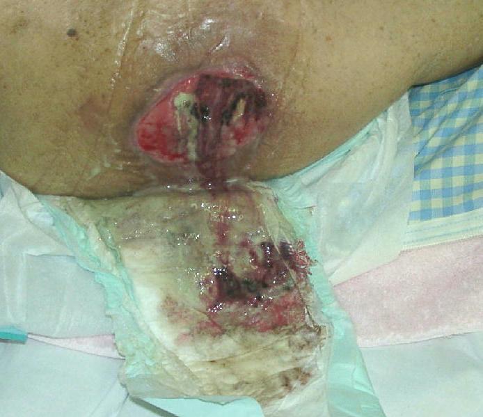 Moist Wound Therapy Exude Management Ideal level is scant to minimal Moderate to High levels Risk of maceration Chronic