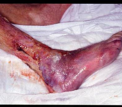 Tissue Perfusion/Blood Flow Oxygen is required in all phases of wound healing Arterial disease and edema (venous and