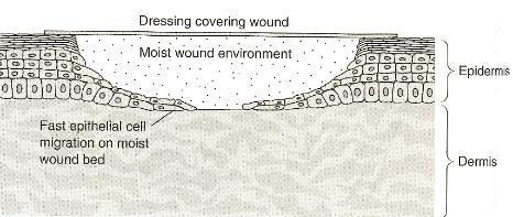 Moist Wound Therapy Current principle for