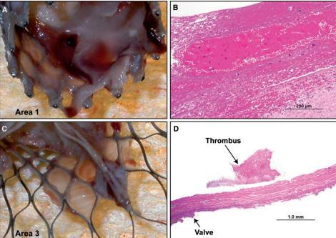 Histopathological studies of the CoreValve apparatus show a similar timeline for the endothelization of the transcatheter device 2.