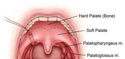 Expansion Sphincter Pharyngoplasty Lateral Pharyngoplasty Identifying the Sites: