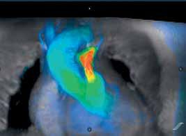 Evaluating Pulmonic Stenosis and Aortic Regurgitation with ViosWorks/4D Flow Case courtesy of Dr. Melany Atkins, Fairfax Radiological Consultants, Fairfax, VA.