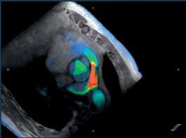 The patient had a history of congenital aortic stenosis status post-ross procedure. He has undergone routine follow up for known neoaortic root dilatation.
