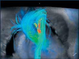Dedicated ViosWorks/4D Flow performed after administration of 10 cc of intravenous ABLAVAR prior to traditional MRA imaging.