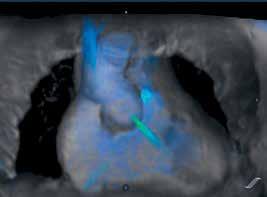 3D image from the 4D Flow dataset demonstrating the ascending aorta and pulmonary outflow tract/main pulmonary arteries with streamline overlay.