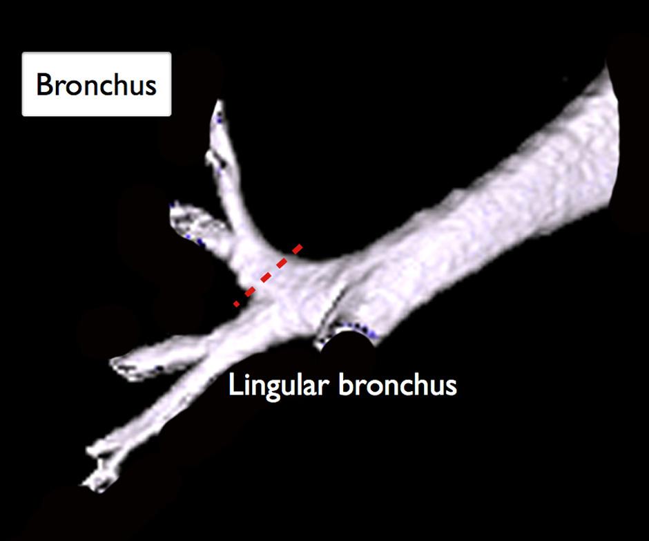 198 Gossot. Thoracoscopic trisegmentectomy A B C Figure 2 Anatomical landmarks. (A) Bronchi; (B) Arteries; (C) Veins. Dotted lines: level of division.