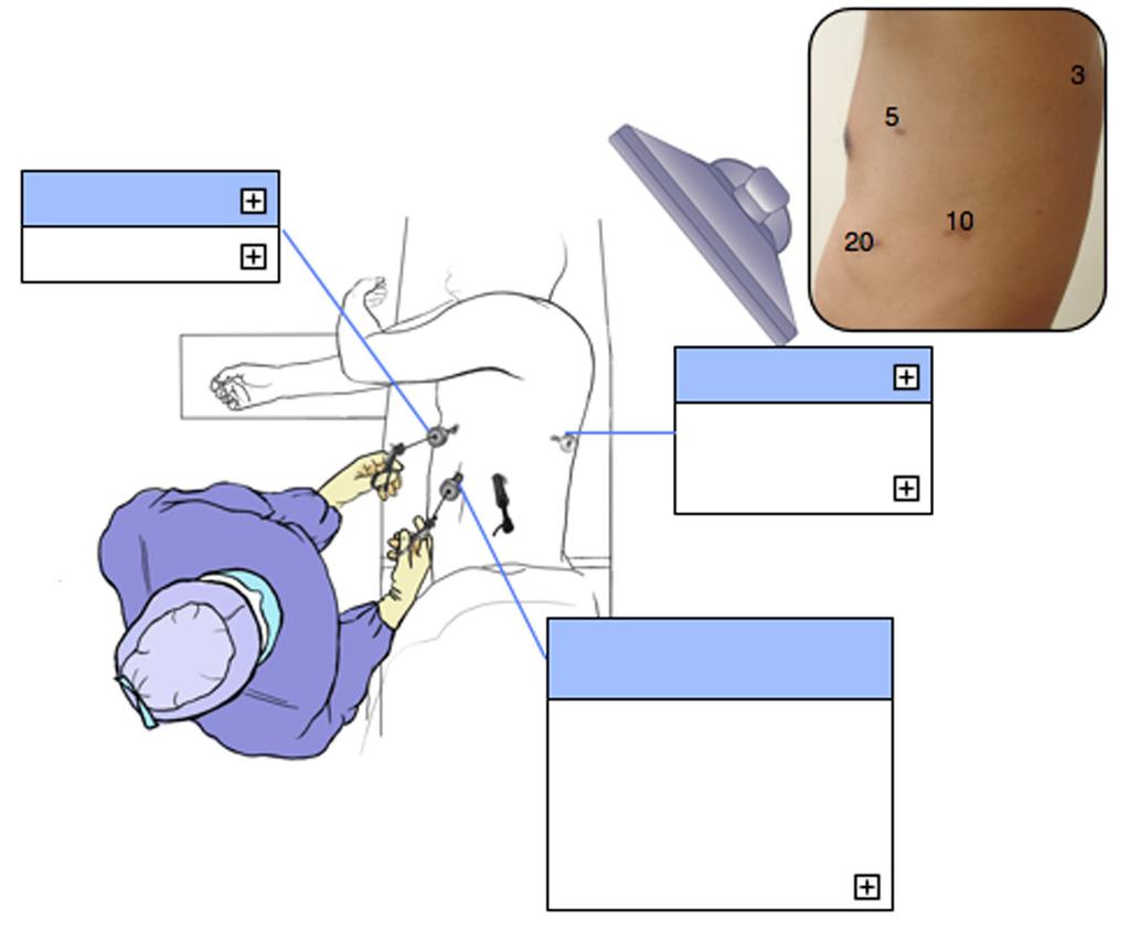 Annals of cardiothoracic surgery, Vol 3, No 2 March 2014 199 5 mm working Grasping forceps Additional 3 mm Suction device Grasping forceps Retracting device Figure 3 Ports for totally thoracoscopic