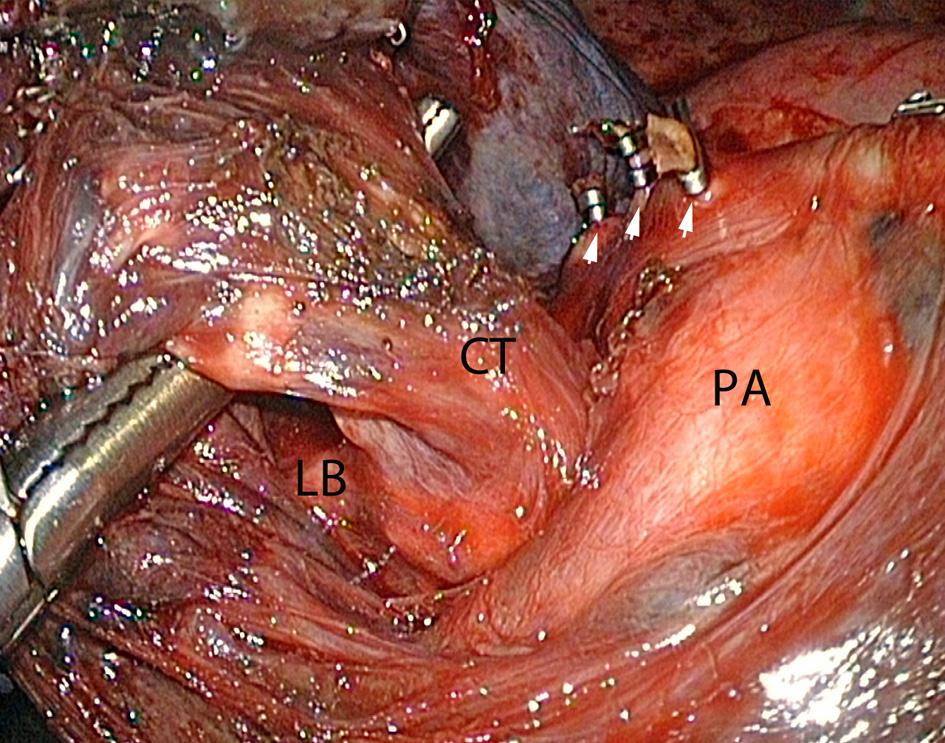 5B; v Twisting of the lingular segments when the anterior part of the fissure is loose.