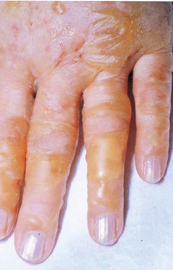 Figure 4. Linear IgA bullous dermatosis bullous lesions on the hands. Figure 6.