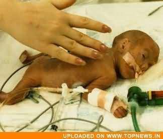 Hyaline Membrane Disease 1/2 or respiratory distress syndrome, is a lung condition that affects premature babies. underdevelopment of the lungs of these infants.