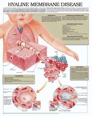Hyaline Membrane Disease 2/2 The term hyaline membrane refers to the clear, glassy membranes found in the lungs of babies that die of the