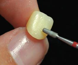 6.1 GLAZING The multi-layered zirconia is designed to achieve esthetic results by using glaze method at final process.