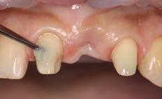 Pretreatment of the abutments (C) Apply Tooth Primer, allow it to react for 20
