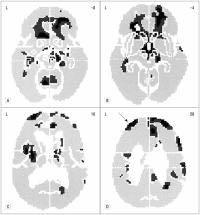 Figure 3. Combining transcranial magnetic stimulation (TMS) with functional imaging reveals TMS neurophysiological effects. Four transverse positron emission tomography images from Kimbrell et al.