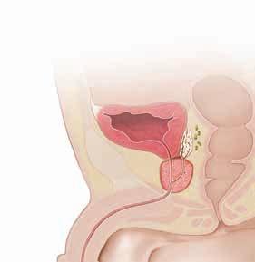 Cystectomy Cystectomy is the surgical removal of the bladder. This surgery may be suggested for high-grade bladder cancer or for muscle-invasive or metastatic bladder cancer.