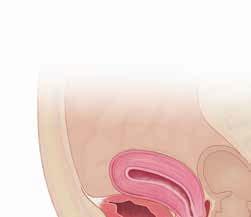 Removing the Bladder The surgery is done in the hospital. You ll be given general anesthesia, which puts you in a state like deep sleep throughout the procedure.
