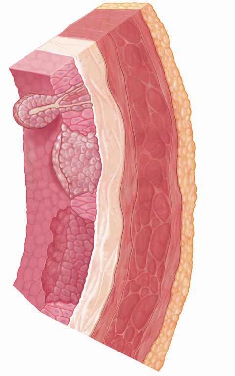 When Bladder Cancer Forms Cancer is a disease in which cells begin changing and growing out of control. The cells may form a lump of tissue (tumor). In time, the cancer cells destroy healthy tissue.