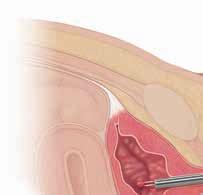 Transurethral Resection (TUR) If the cancer is in an early stage (superficial), it may be removed using cystoscopy.
