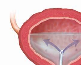 Intravesical Therapy Certain types of bladder tumors are hard to remove using surgical procedures like TUR alone. In these cases, special medications may be placed into the bladder.