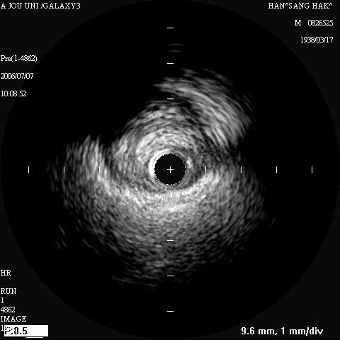 69 y-o Male Stable Angina MLD