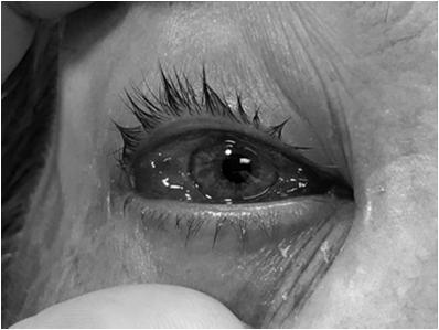 56 yo female, EW Presented to outside Ophthalmologist Diagnosed with viral conjunctivitis, but viral