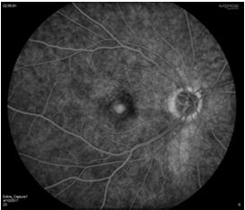 AMD Neovascular Given Lucentis, after one injection improved to 20/40 Clinical Trial of Implant Device OD Inserted