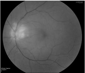 retinopathy OS Patient is a nurse,